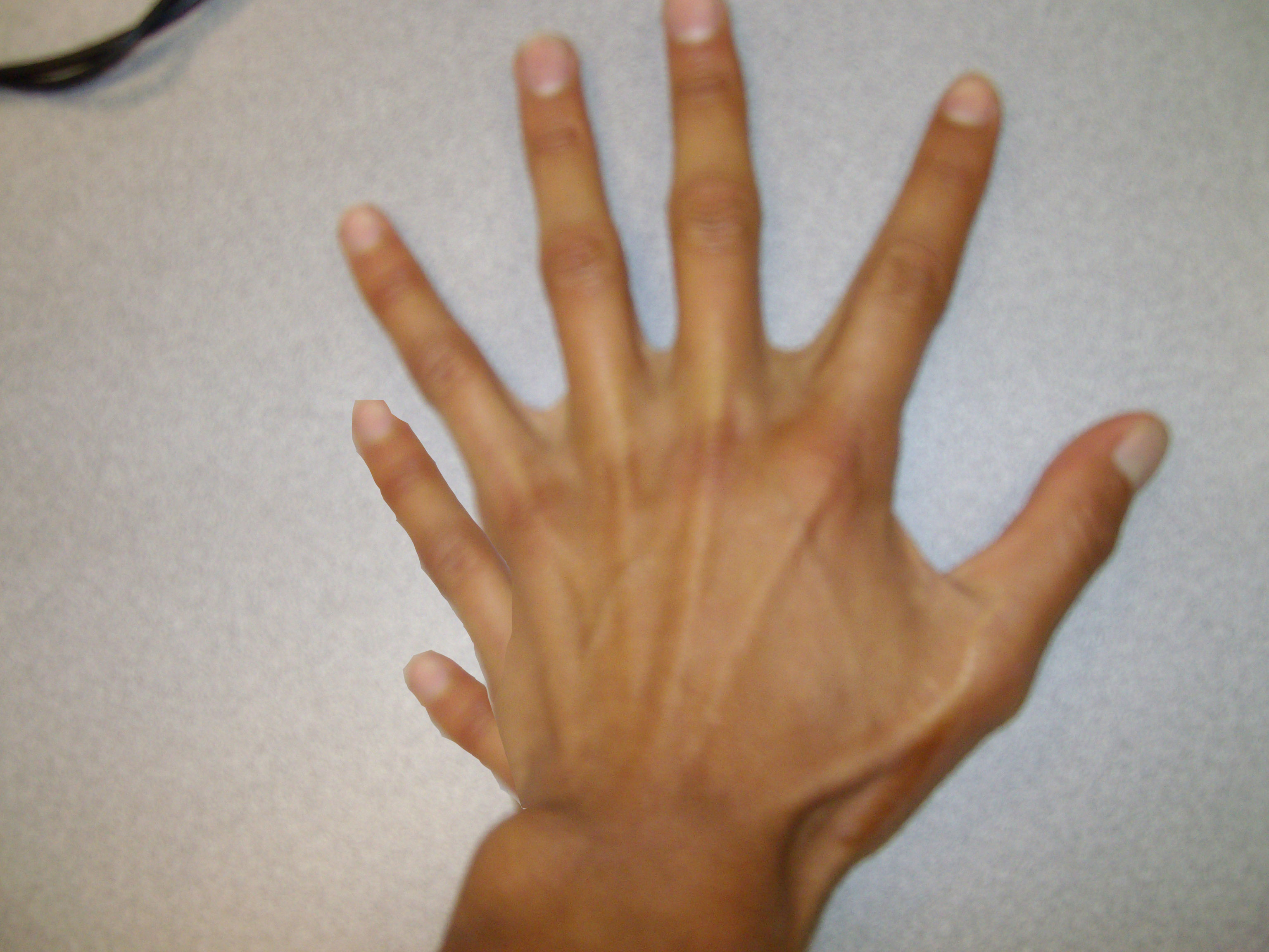 2 пальца на запястье. Радиальная преаксиальная полидактилия. Человек с семя пальцами.